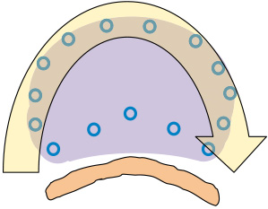 直腸前面以外の辺縁ニードルへの線源挿入イメージ図