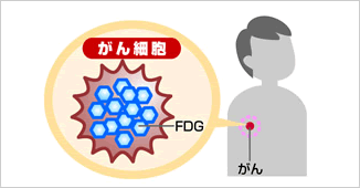 がん細胞とFDG2