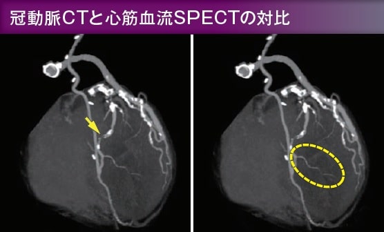 冠動脈CTと心筋血流SPECTの対比