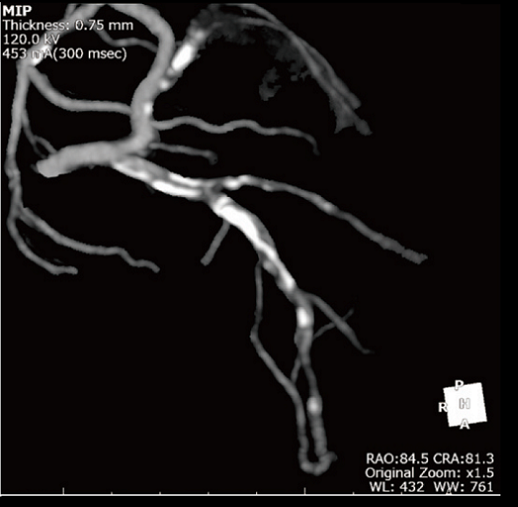 冠動脈CTA右冠動脈