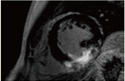 遅延造影MRI　画像例