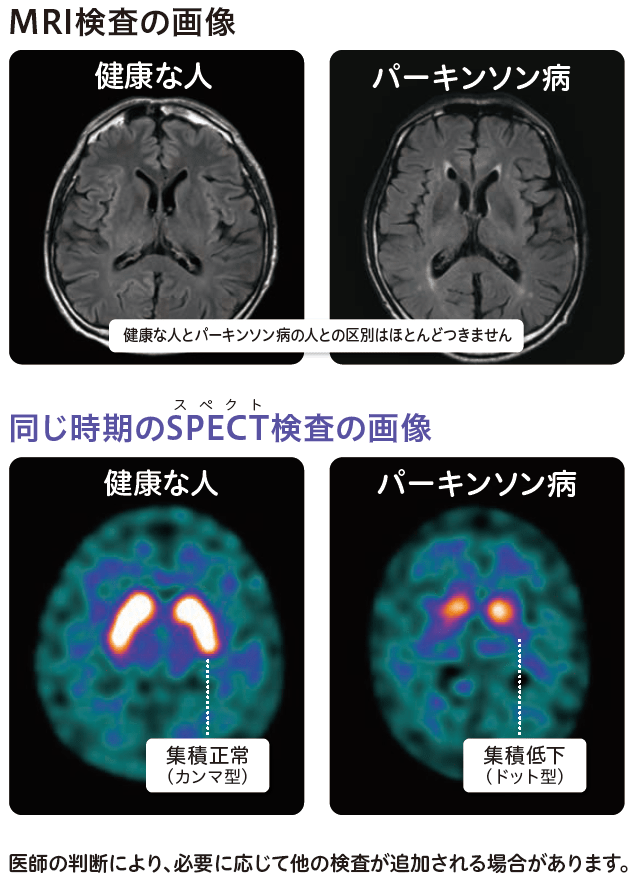 MRI検査の画像と同じ時期のSPECT検査の画像