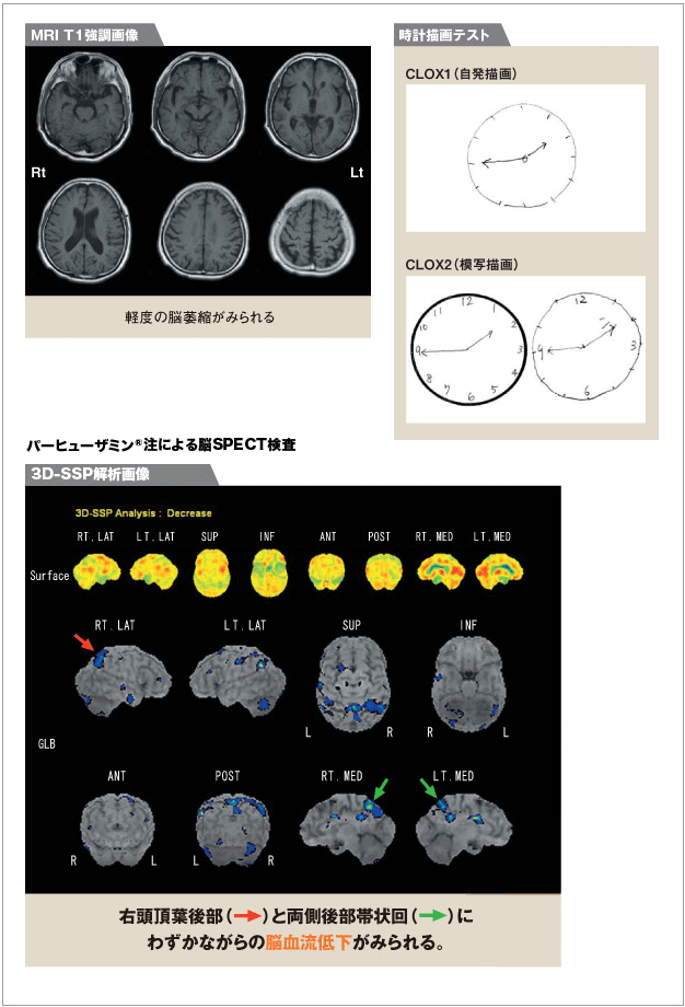 MRIT1強調画像　時間描画テスト　パーヒューザミン注による脳SPECT検査