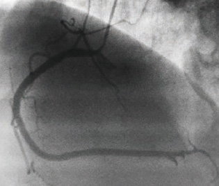 冠動脈造影では右冠動脈に有意狭窄を認めなかった
