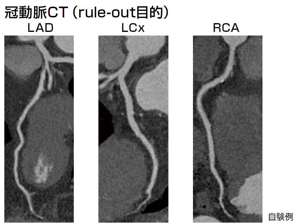 図2curved MPR画像。前下行枝の近位部に中等度の狭窄が認められたが、回旋枝や右冠動脈には狭窄病変は認められなかった