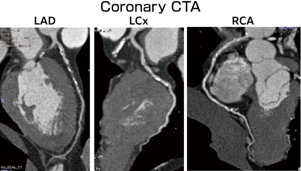 図1冠動脈CTAの結果。3枝病変を疑う所見を認めた。
