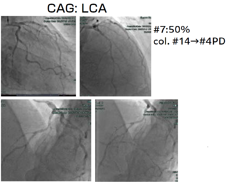 図5LCA左冠動脈のCAG結果。7番の狭窄は50%軽度と判断された