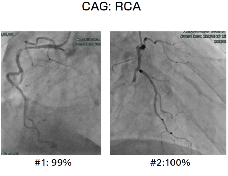 図6RCAのCAG結果。2番の血管は完全閉塞であった。