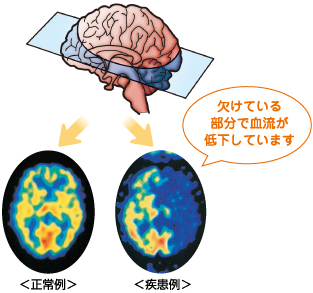 脳血流シンチグラフィ正常例と疾患例