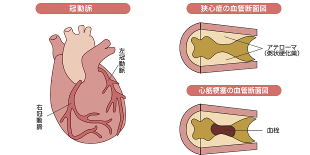冠動脈・狭心症の血管断面図・心筋梗塞の血管断面図