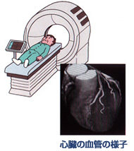 血管CT検査、写真：心臓の血管の様子