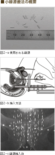 小線源療法の概要