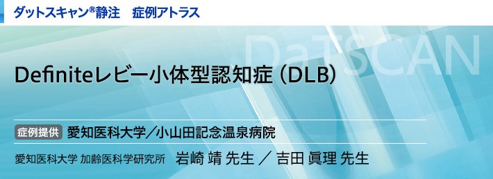 ダットスキャン静注 症例アトラス Definiteレビー小体型認知症（DLB）症例提供愛知医科大学／小山田記念温泉病院　愛知医科大学 加齢医科学研究所 岩崎 靖／吉田 眞理