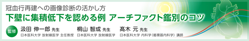 冠血行再建への画像診断の活かし方 下壁に集積低下を認める例 アーチファクト鑑別のコツ