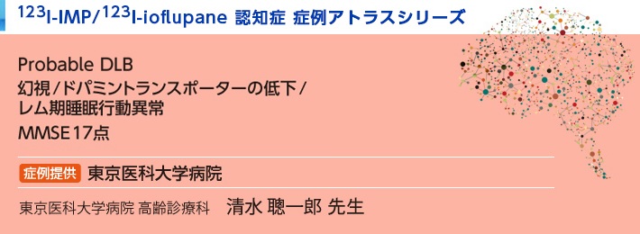 123I-IMP/123I-ioflupane認知症 症例アトラスシリーズ レビー小体型認知症  東京医科大学病院 Probable DLB 幻視/ドパミントランスポーターの低下/レム期睡眠行動異常 MMSE17点 東京医科大学病院 高齢診療科　清水 聰一郎 紹介した症例は臨床症例の一部を紹介したもので、全ての症例が同様な結果を示すわけではありません。 3D-SSP/DaTViewによる画像解析は核医学画像解析ソフトウェアmedi+FALCONを使用することで実施可能です。