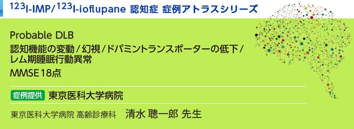 123I-IMP/123I-ioflupane認知症 症例アトラスシリーズ レビー小体型認知症  東京医科大学病院 Probable DLB 認知機能の変動/幻視/ドパミントランスポーターの低下/レム期睡眠行動異常MMSE18点 東京医科大学病院 高齢診療科　清水 聰一郎 紹介した症例は臨床症例の一部を紹介したもので、全ての症例が同様な結果を示すわけではありません。 3D-SSP/DaTViewによる画像解析は核医学画像解析ソフトウェア medi+FALCONを使用することで実施可能です。