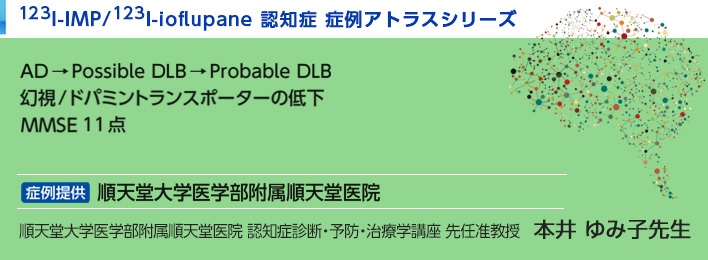 123I-IMP/123I-ioflupane認知症 症例アトラスシリーズ レビー小体型認知症  AD → Possible DLB → Probable DLB 幻視/ドパミントランスポーターの低下 MMSE 11点 順天堂大学医学部附属順天堂医院 順天堂大学医学部附属順天堂医院 認知症診断・予防・治療学講座 先任准教授　本井 ゆみ子先生 紹介した症例は臨床症例の一部を紹介したもので、全ての症例が同様な結果を示すわけではありません。3D-SSP/ZSAM/DaTViewによる画像解析は核医学画像解析ソフトウェア medi+FALCONを使用することで実施可能です。