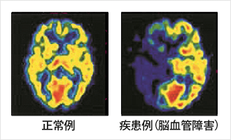 正常例 疾患例(脳血管障害)