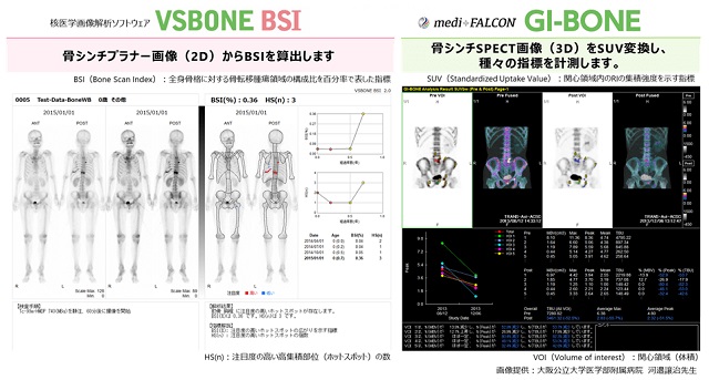 VSBONEとGI-BONE