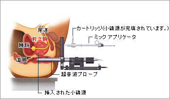 線源挿入時のイメージイラスト