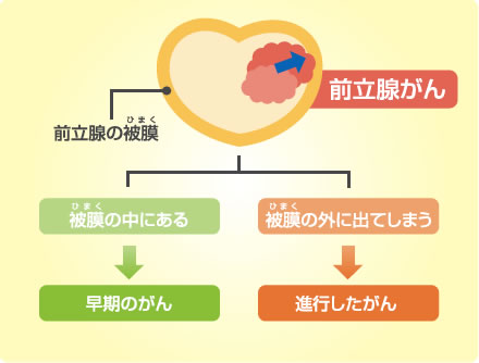 前立腺がんにおける早期がんと進行がんのイラスト