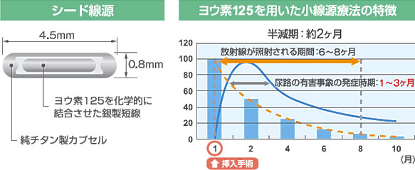 シード線源のイメージイラストとヨウ素125を用いた小線源療法の特徴