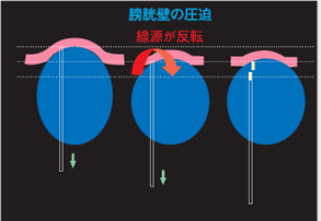 膀胱壁の圧迫図