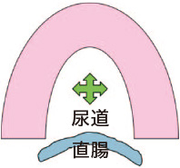 尿道、直腸の位置と辺縁ニードルへの線源挿入注意点