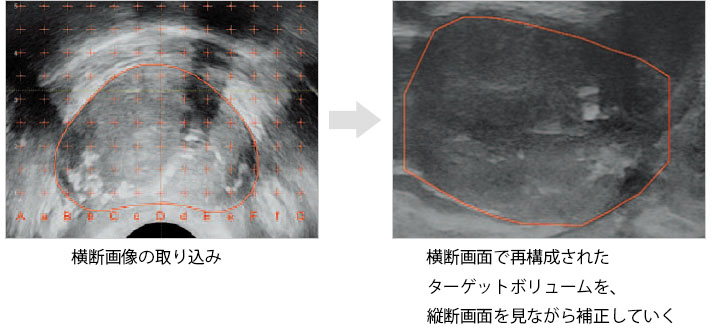 横断画像と補正方法の図