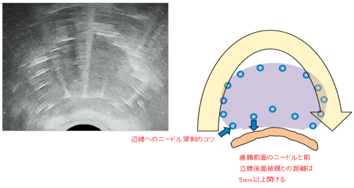 ニードルの配置間隔イメージ図