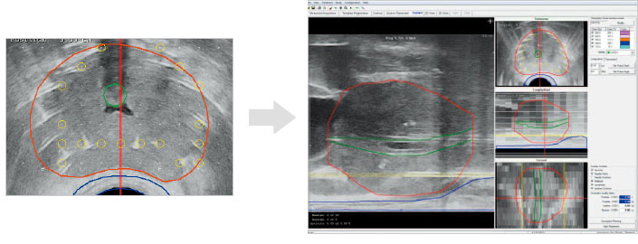 縦断画像をリアルタイムの前立腺縦断画像と補正する
