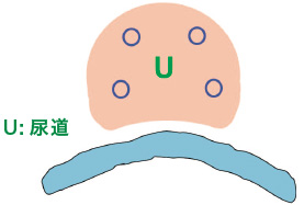 内部ニードルと尿道の位置関係