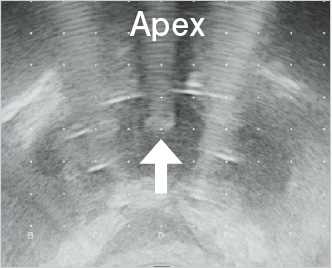 Apexにおける尿道とニードルの距離画像