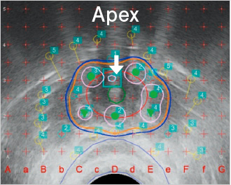 尿道の過線量を避けるためにApex