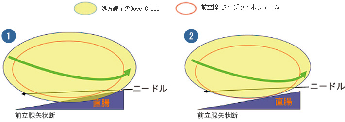 ニードルの高さ調整　イメージ図