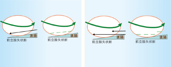 前立腺尖部での直腸の高線量を避けるイメージ図