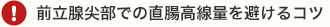 前立腺尖部での直腸高線量を避けるコツ