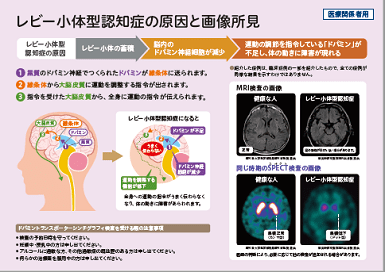 レビー小体型認知症の原因と鑑別が必要な病気の画像所見