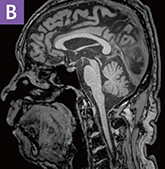T1強調像B画像