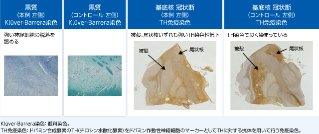 黒質（本例 左側）Kluver-Barrera染色強い神経細胞の脱落を認める黒質（コントロール 左側）Kluver-Barrera染色基底核 冠状断（本例 左側）TH免疫染色被殻、尾状核いずれも強いTH染色性低下被殻 尾状核基底核 冠状断（コントロール 左側）TH免疫染色TH染色で良く染まっている
				Kluver-Barrera染色： 髄鞘染色。TH免疫染色： ドパミン合成酵素のTH(チロシン水酸化酵素）をドパミン作動性神経細胞のマーカーとしてＴＨに対する抗体を用いて行う免疫染色。