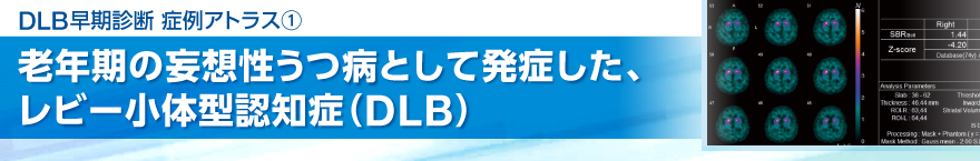 症例アトラス老年期の妄想性うつ病として発症した、レビー小体型認知症(DLB)