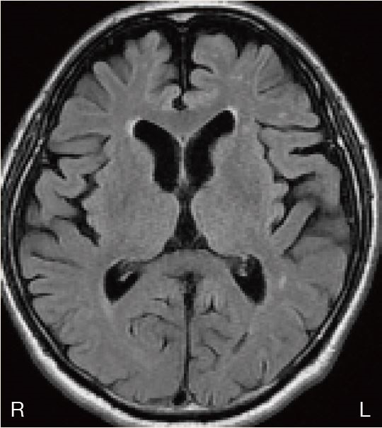頭部MRI1