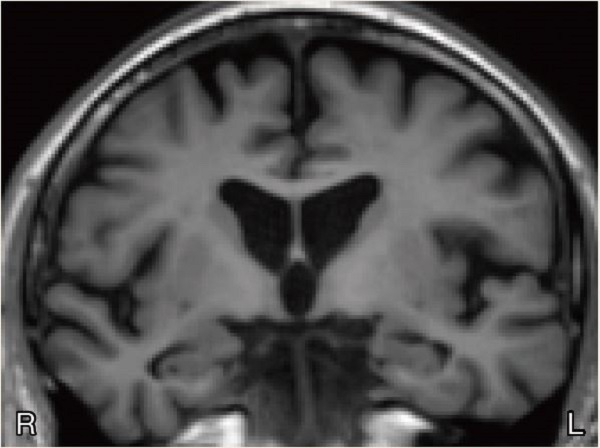 頭部MRI2