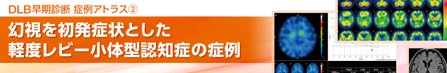 幻視を初発症状とした軽度レビー小体型認知症の症例