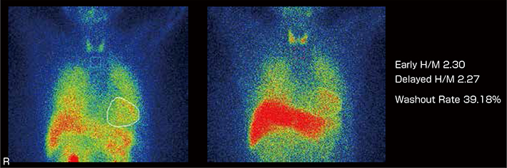 Swedd Scans Without Evidence Of Dopaminergic Deficit 日本メジフィジックス株式会社