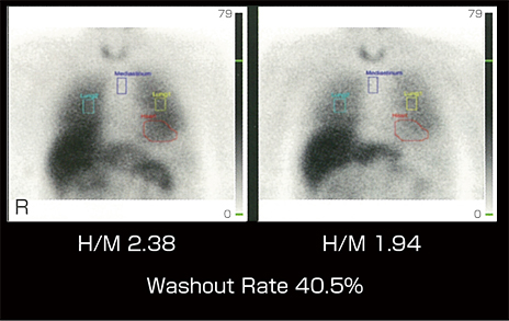 多系統萎縮症 Multiple System Atrophy Msa P 日本メジフィジックス株式会社