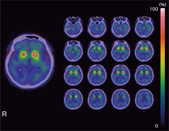 SPECT-CT Fusion 画像