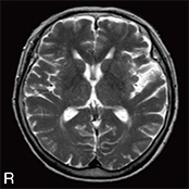 T2WI画像