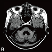 T1WI画像
