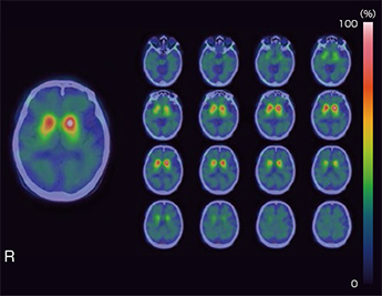 SPECT-CT Fusion 画像